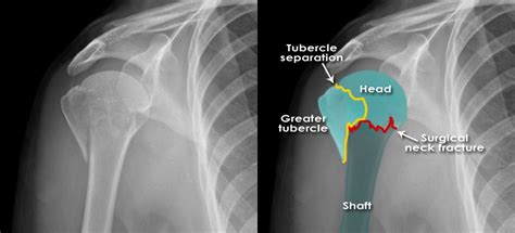 posterior humerus fracture diagram